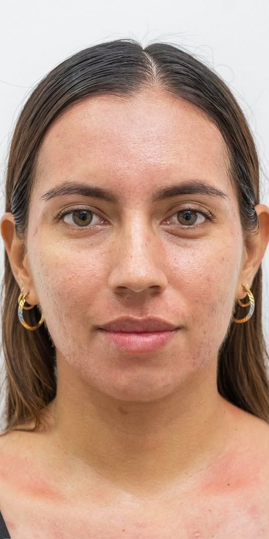 Antes: Cicatrices en rostro y escote, piel