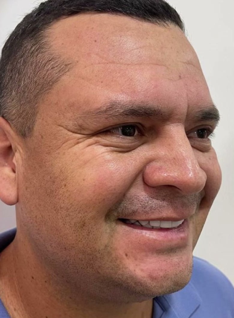 Antes: Toxina Botulínica, rostro · patas de gallo